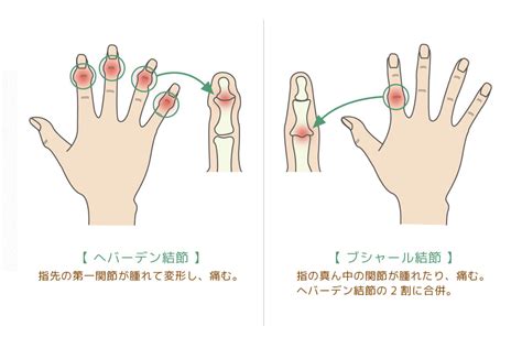 手指第一節|指の第一関節とは？痛みの原因と対処法を徹底解説｜ 